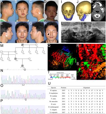 ITPR1 Mutation Contributes to Hemifacial Microsomia Spectrum